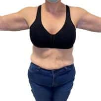 braquiplastia despues