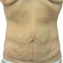 Abdominoplastía Antes