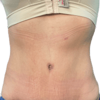 Abdominoplastía Después