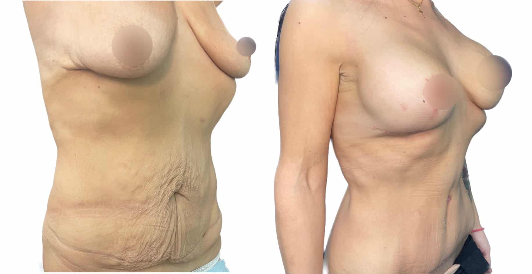 cirugia combianda postbariátrica