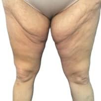 dermolipectomia antes